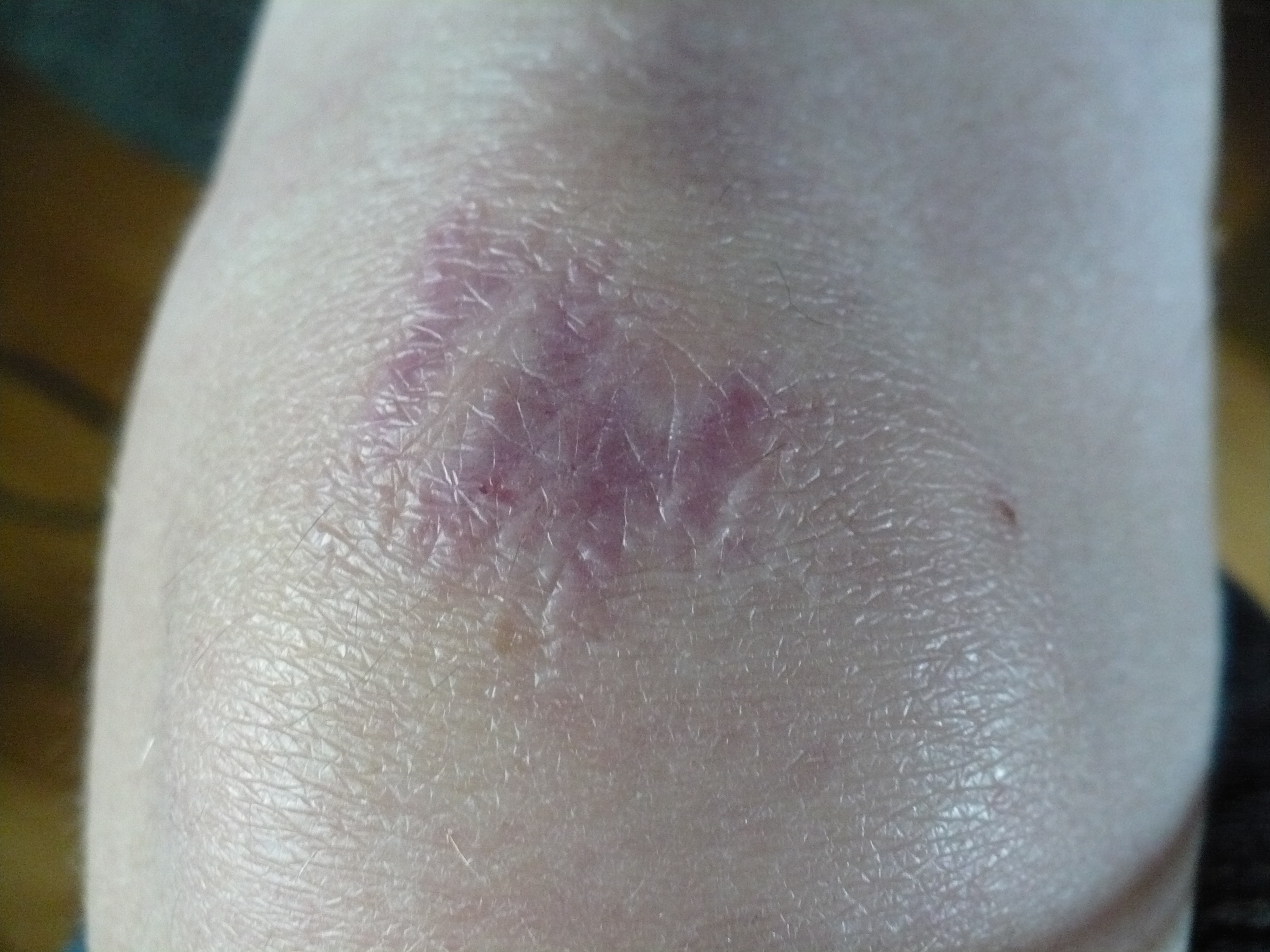 My Knee Today